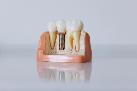 Tratamiento tornillo / Clínica Sabana Norte Integra Médica Dental